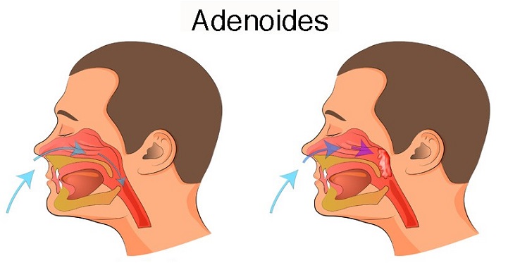 Adenoids in Adults